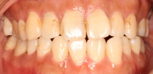 田村1 術前　◎